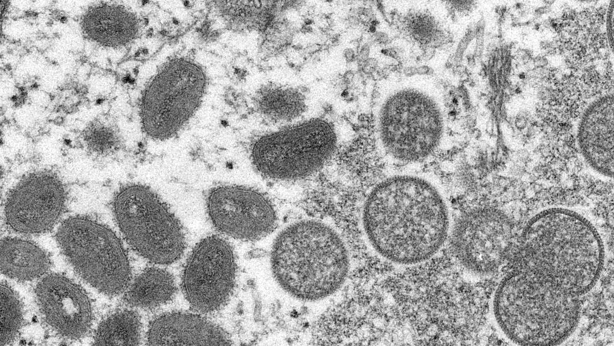 6th, 7th suspected monkeypox cases identified in Sacramento County