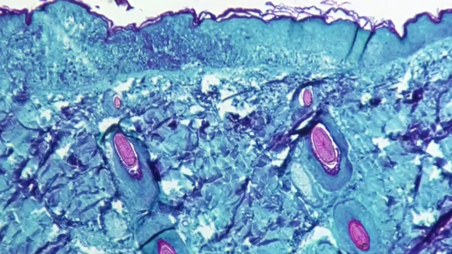 4 New Suspected Monkeypox Cases Discovered In Sacramento County;  Total Now 14 – CBS Sacramento