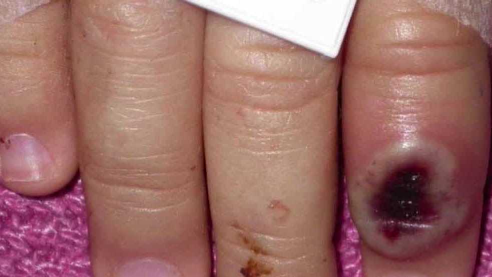 Advocates stress using lessons learned from AIDS crisis in monkeypox vaccine guidelines