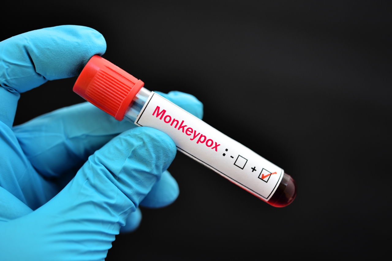 7 new possible cases of monkeypox in Sacramento County