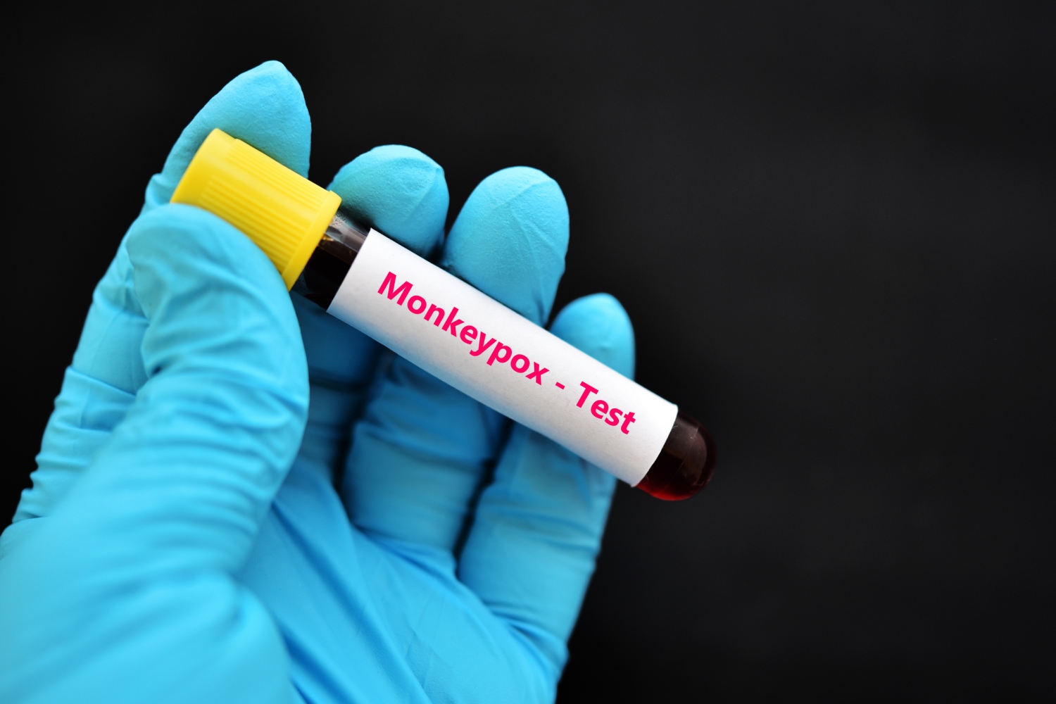 1st Monkeypox Cases Now Identified In Solano, Stanislaus Counties - CBS Sacramento