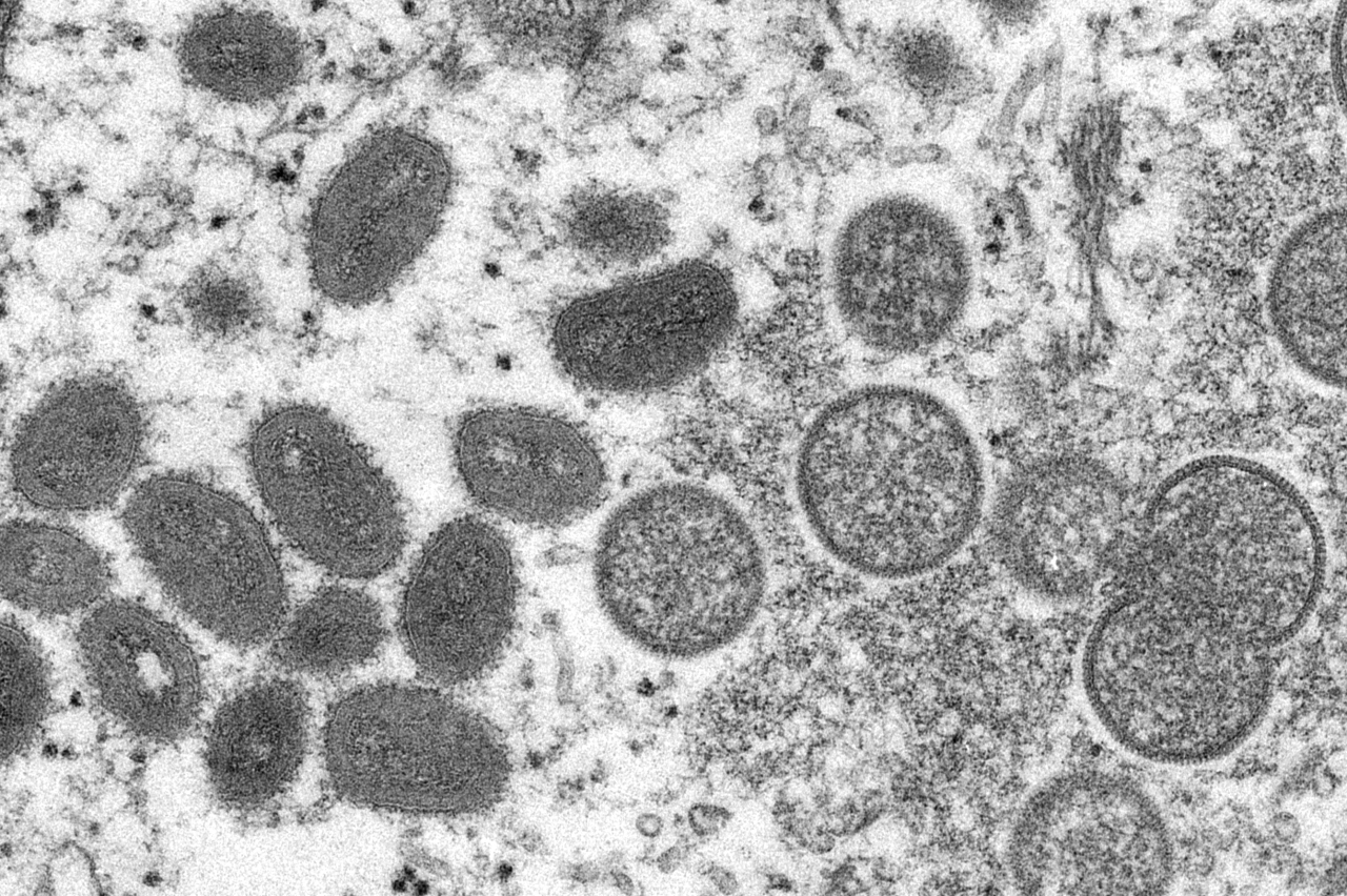 Rise in Fresno County monkeypox cases