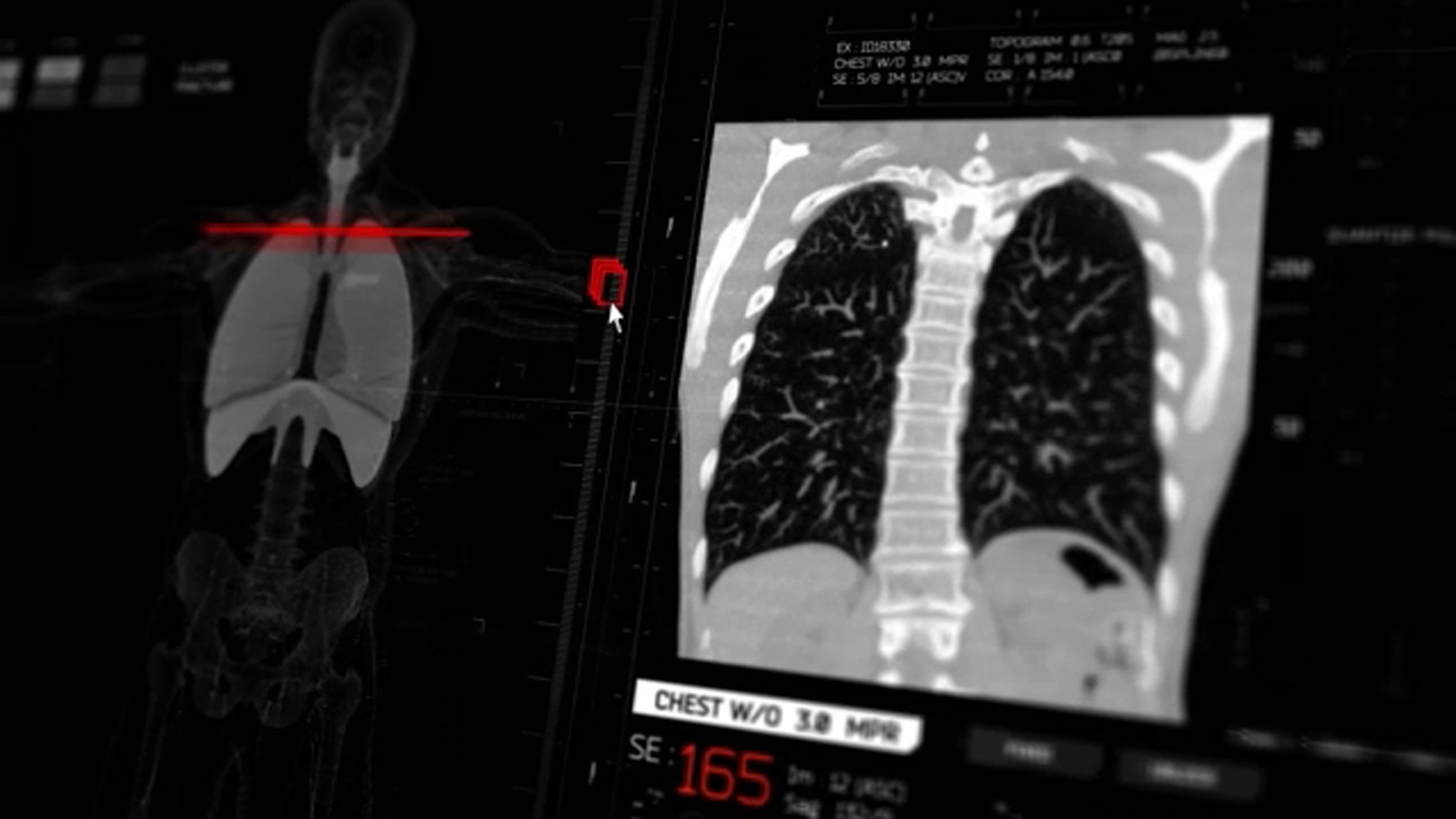 Local doctor stresses lung cancer screenings for high-risk patients